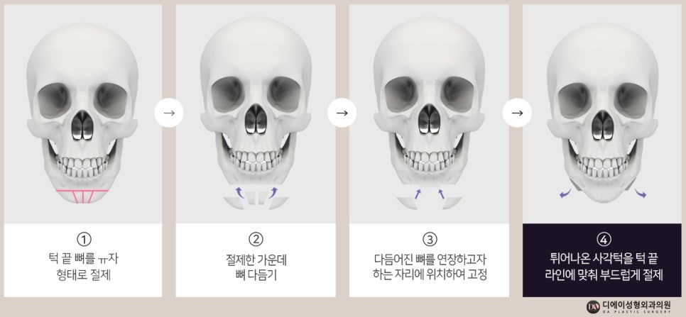 자연스러운 남자성형을 원한다면 관련 이미지 16
