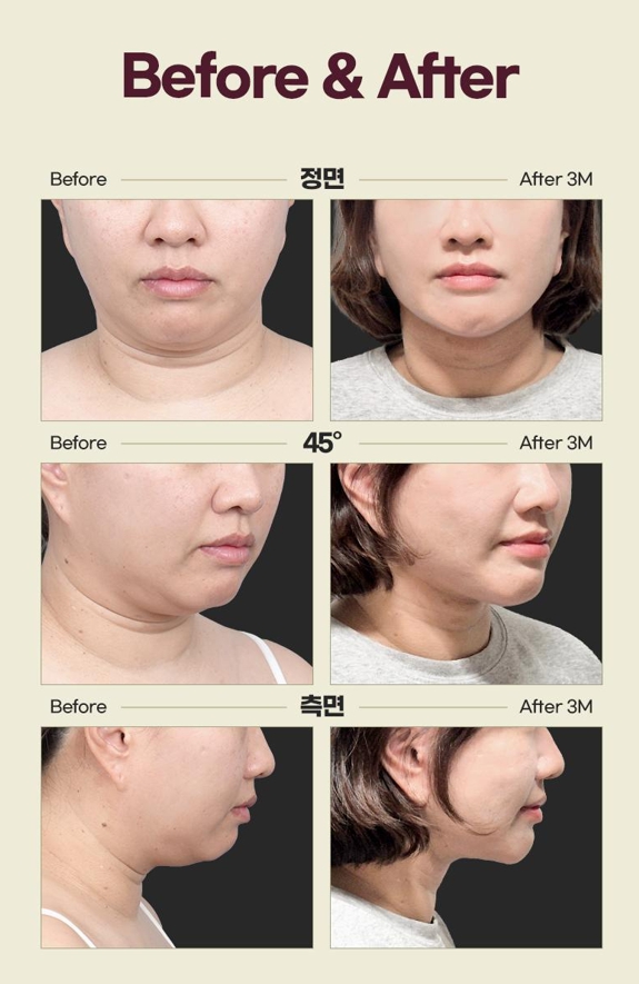 Double Chin Removal Surgery: Essential Information from Effects to Recovery Time image 2