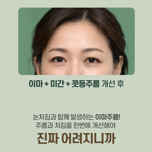 이마주름과 눈처짐을 동시에 개선, 수직 이마거상 관련 이미지 7