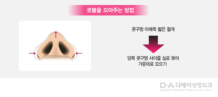 유형별 코성형의 특징과 방법 관련 이미지 16
