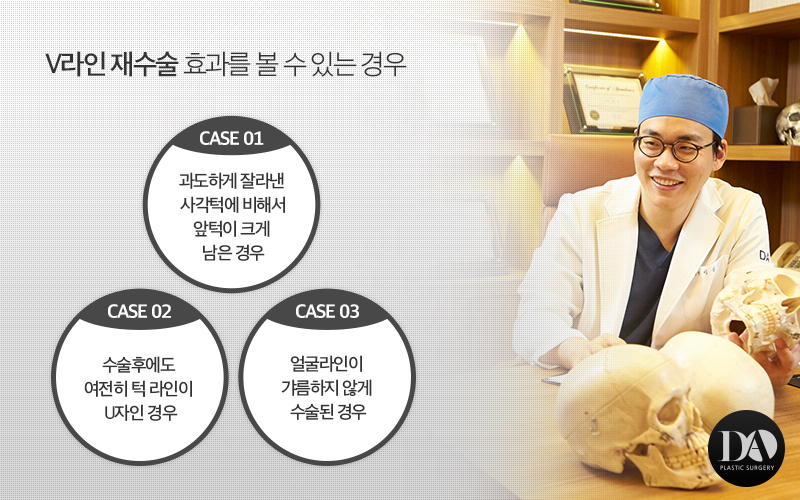 안면윤곽 재수술 체크리스트 관련 이미지 4