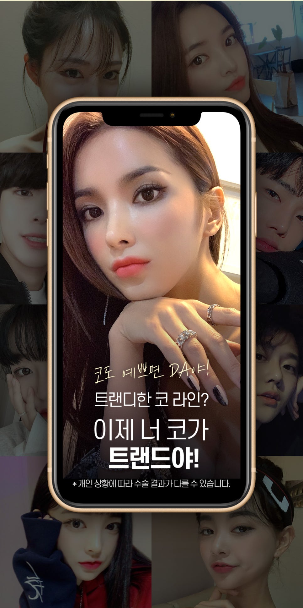 자가연골코성형 알아볼 때 주의사항 관련 이미지 2