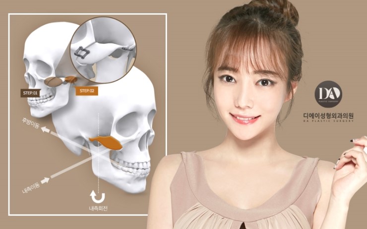 안면윤곽, 어떤 얼굴형이 큰 효과를 볼 수 있나? 관련 이미지 8