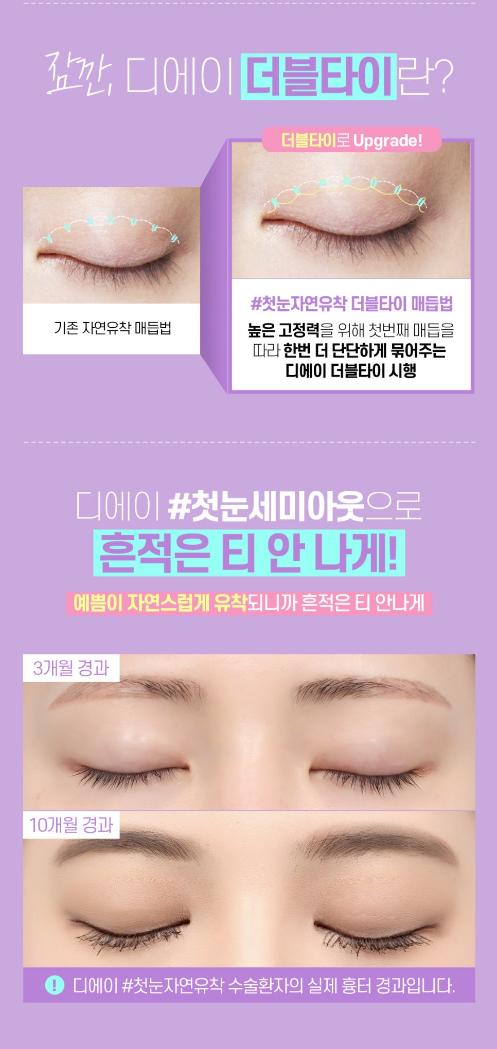 강남 세미아웃라인 잘 하는 곳 [디에이성형외과] 관련 이미지 6