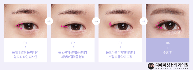 내 눈에 꼭 맞는 수술법은 무엇? 관련 이미지 15