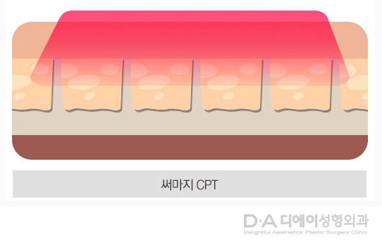 V라인을 위한 리프팅 종류 알아보기 관련 이미지 6