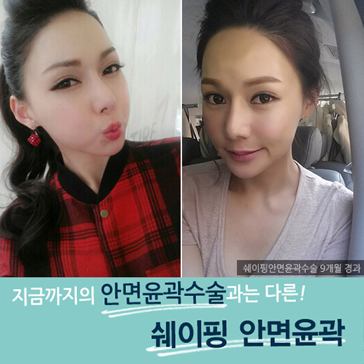 최소 절제, 최상의 효과! DA성형외과 쉐이핑안면윤곽 관련 이미지 6
