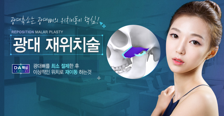 DA 광대 재위치술 관련 이미지 2