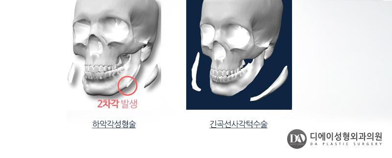 안면윤곽 수술 전 체크사항 관련 이미지 5