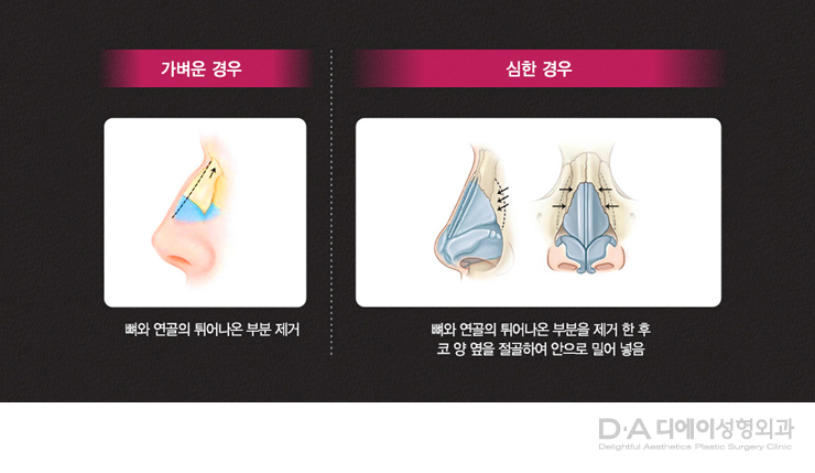 유형별 코성형의 특징과 방법 관련 이미지 14