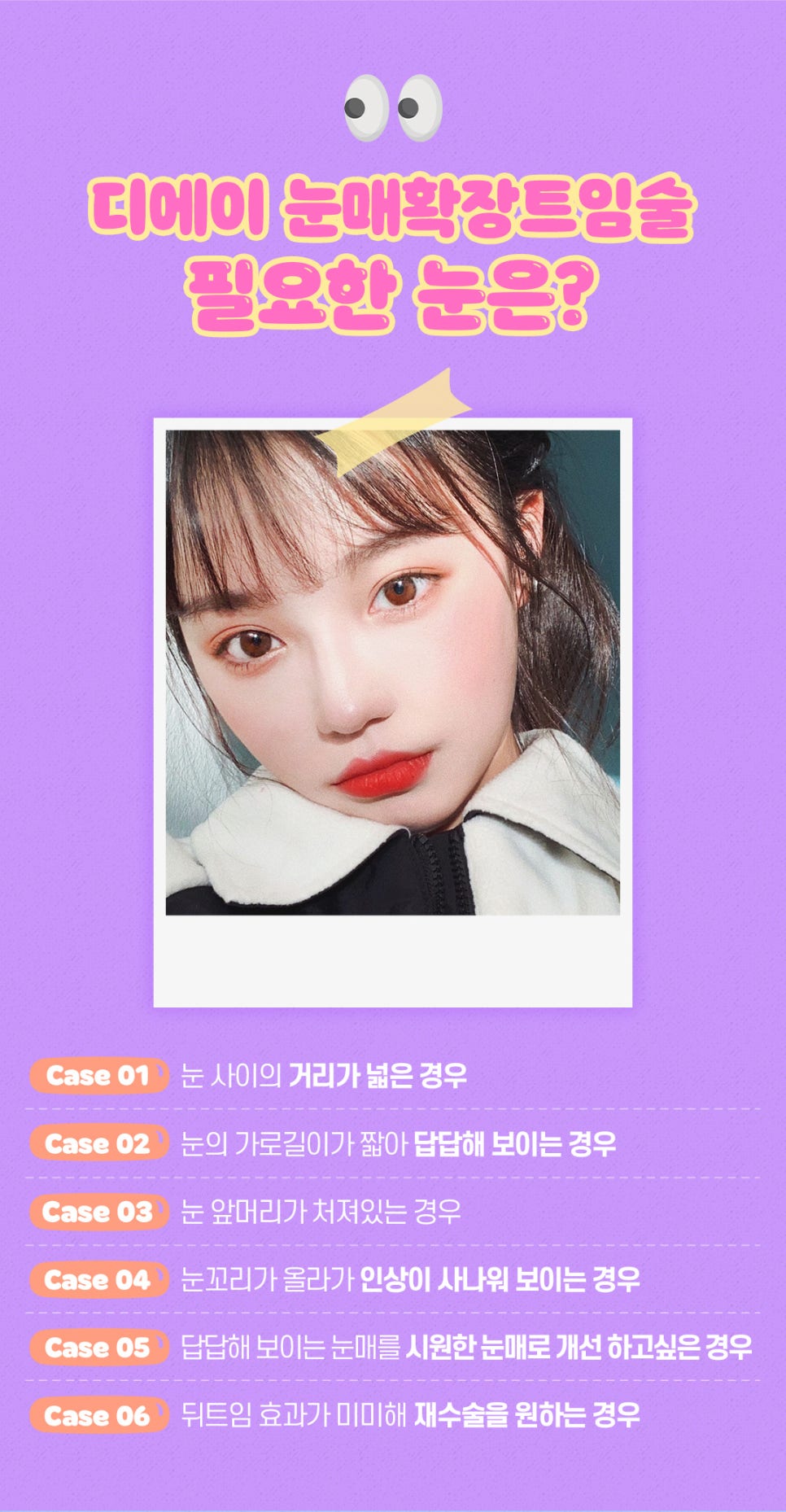 눈매확장트임으로 답답하고 사나운 눈 개선하기 관련 이미지 3