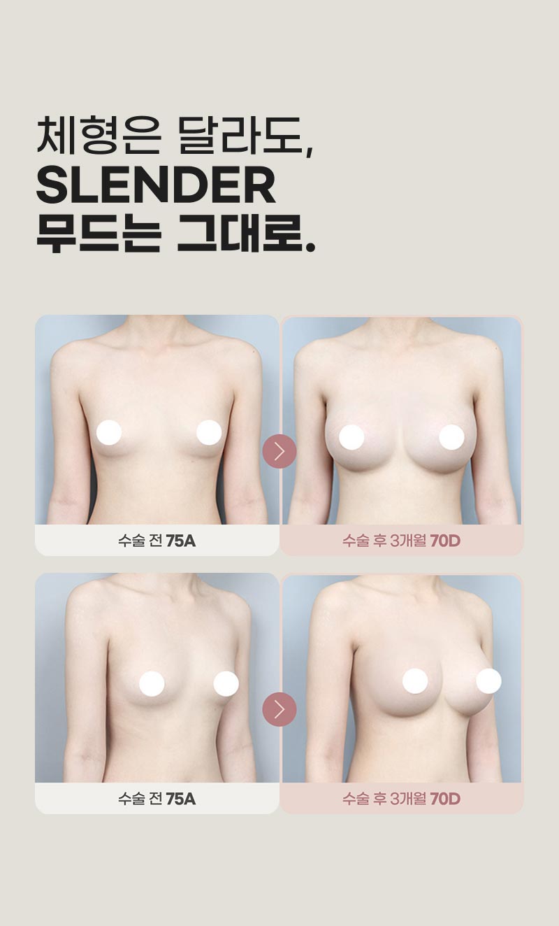 슬렌더 가슴성형, 마른 체형도 자연스러운 가슴라인을 만들 수 있을까? 관련 이미지 9