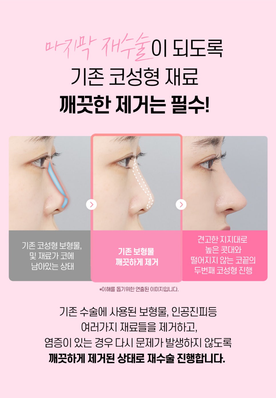 마지막 코재수술 원한다면♡ [DA성형외과] 관련 이미지 9