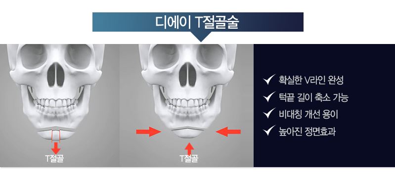 [디에이성형외과] 턱끝성형술 논문 발표 관련 이미지 4