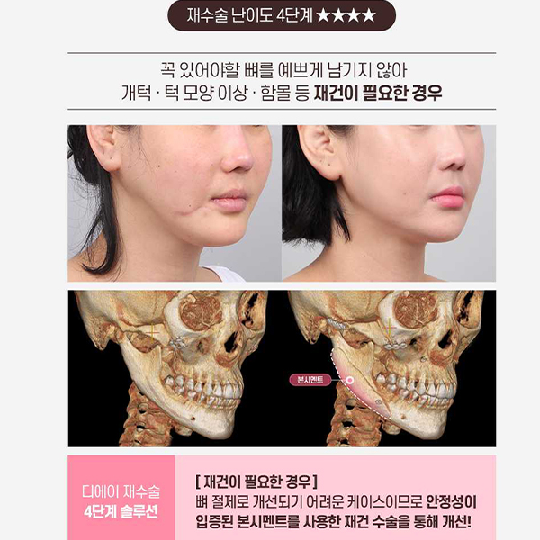 Not Satisfied After Your First Surgery? A Guide to Revision Facial Contouring Surgery image 11