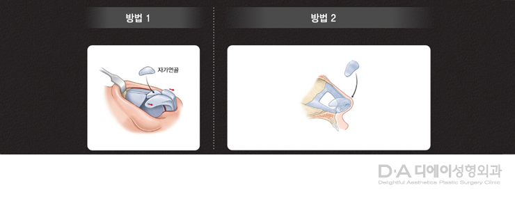 유형별 코성형의 특징과 방법 관련 이미지 10