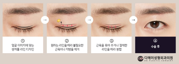 자연스러운 남자성형을 원한다면 관련 이미지 6