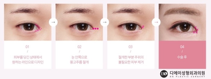 성공적인 눈성형, 관건은 눈형태에 따른 수술법 선택 관련 이미지 13