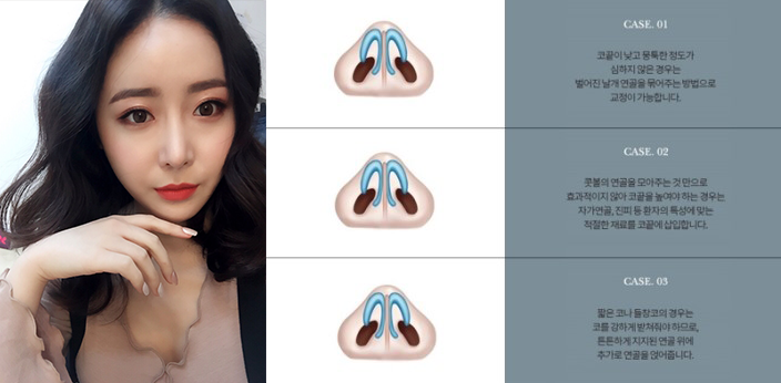 이상적인 코라인을 위한 유형별 코성형 관련 이미지 18