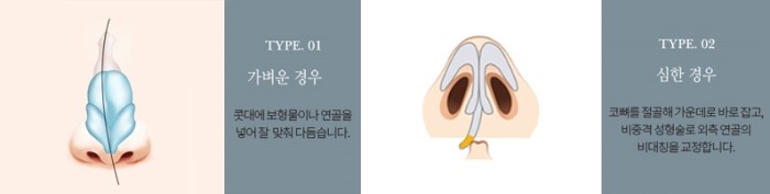 이상적인 코성형, 그 방법은? 관련 이미지 16