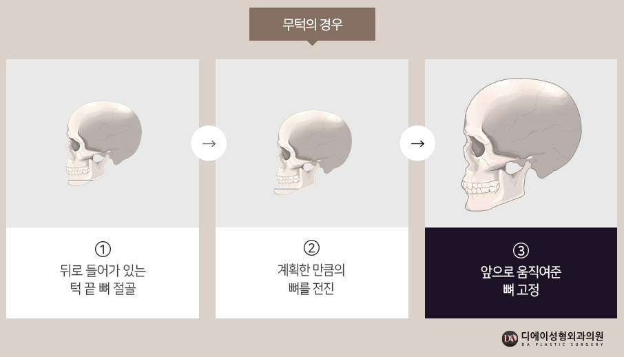 자연스러운 남자성형을 원한다면 관련 이미지 17