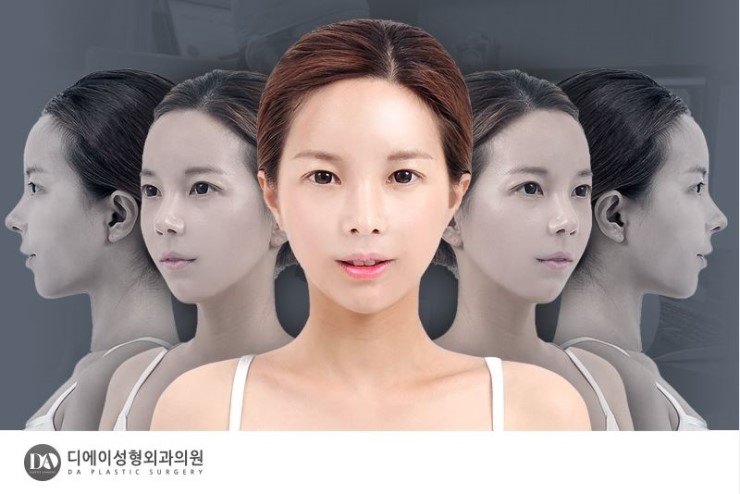 얼굴 유형에 따른 양악수술 솔루션 관련 이미지 16