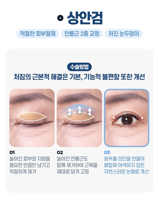 중년 눈성형, 처진 눈꺼풀의 원인에 따라 수술법이 달라집니다 관련 이미지 9