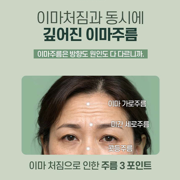 이마주름과 눈처짐을 동시에 개선, 수직 이마거상 관련 이미지 6
