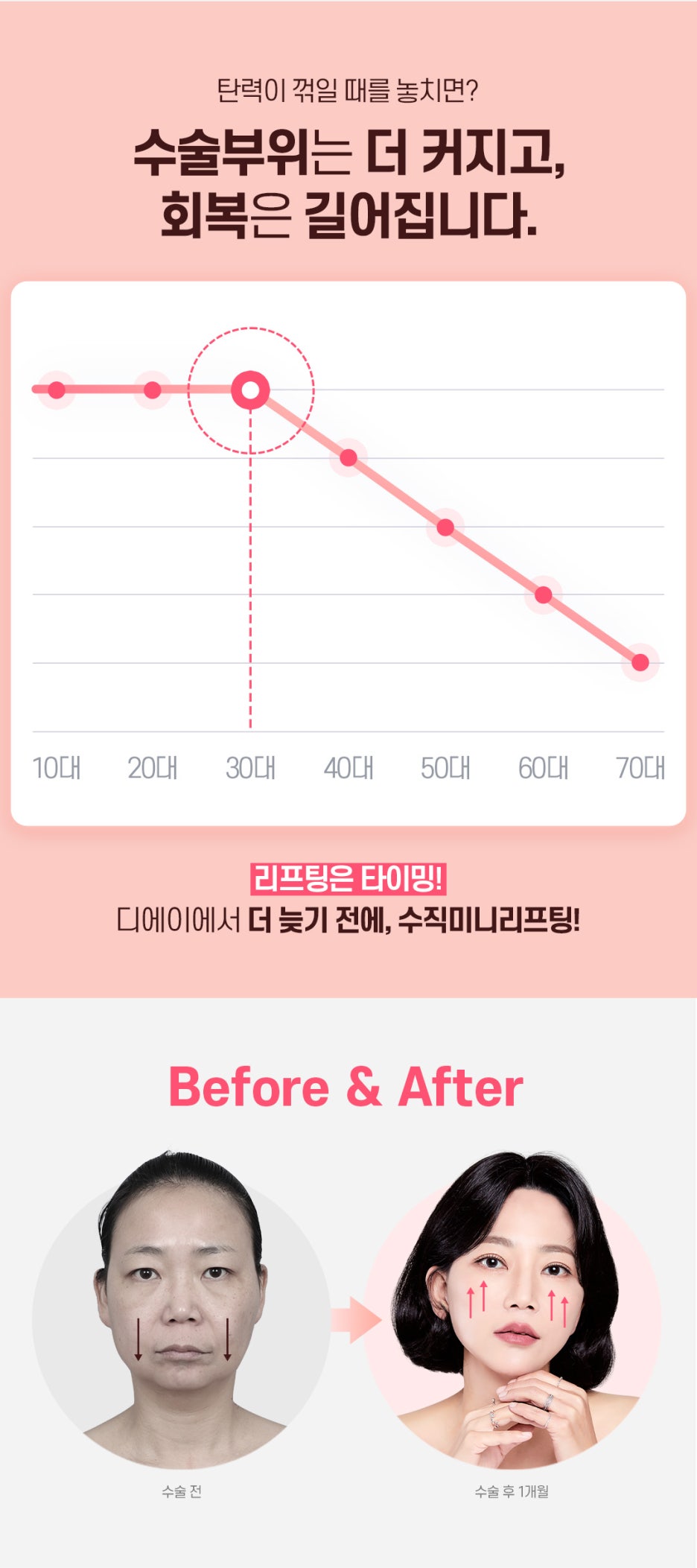 수직미니리프팅 수술법 가격 효과 알아보자면 관련 이미지 6