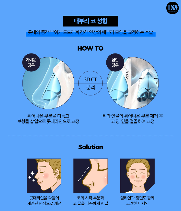 세련된 인상을 만드는 남자 코 성형 BEST 3 관련 이미지 4