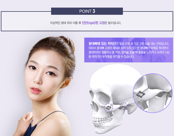 DA 광대 재위치술 관련 이미지 6