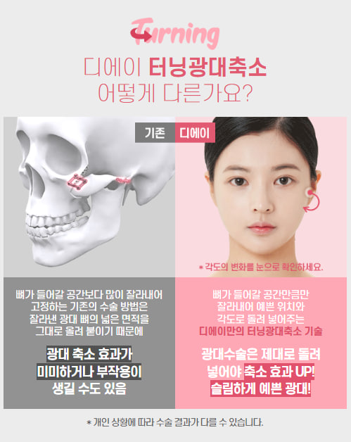 안전하지만 효과적으로, 광대축소술 관련 이미지 5
