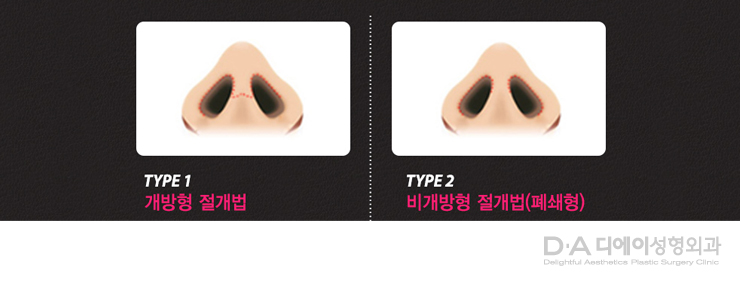 유형별 코성형의 특징과 방법 관련 이미지 7