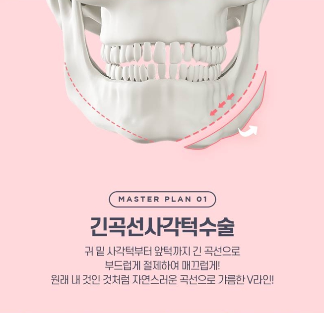 사각턱수술 비용보다 중요한 선택 기준은? 관련 이미지 3