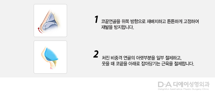 유형별 코성형의 특징과 방법 관련 이미지 9