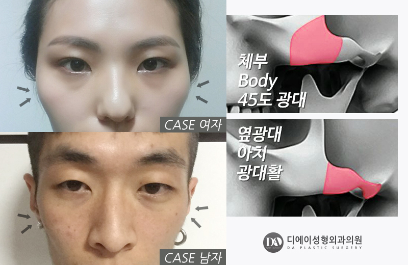 안면윤곽 수술 전 체크사항 관련 이미지 9