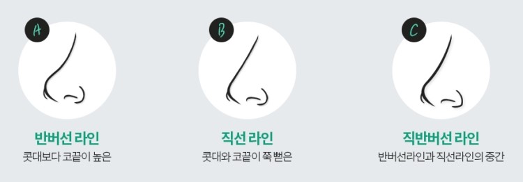 이상적인 코성형? A-Z 코유형별 방법을 알아보자 관련 이미지 5