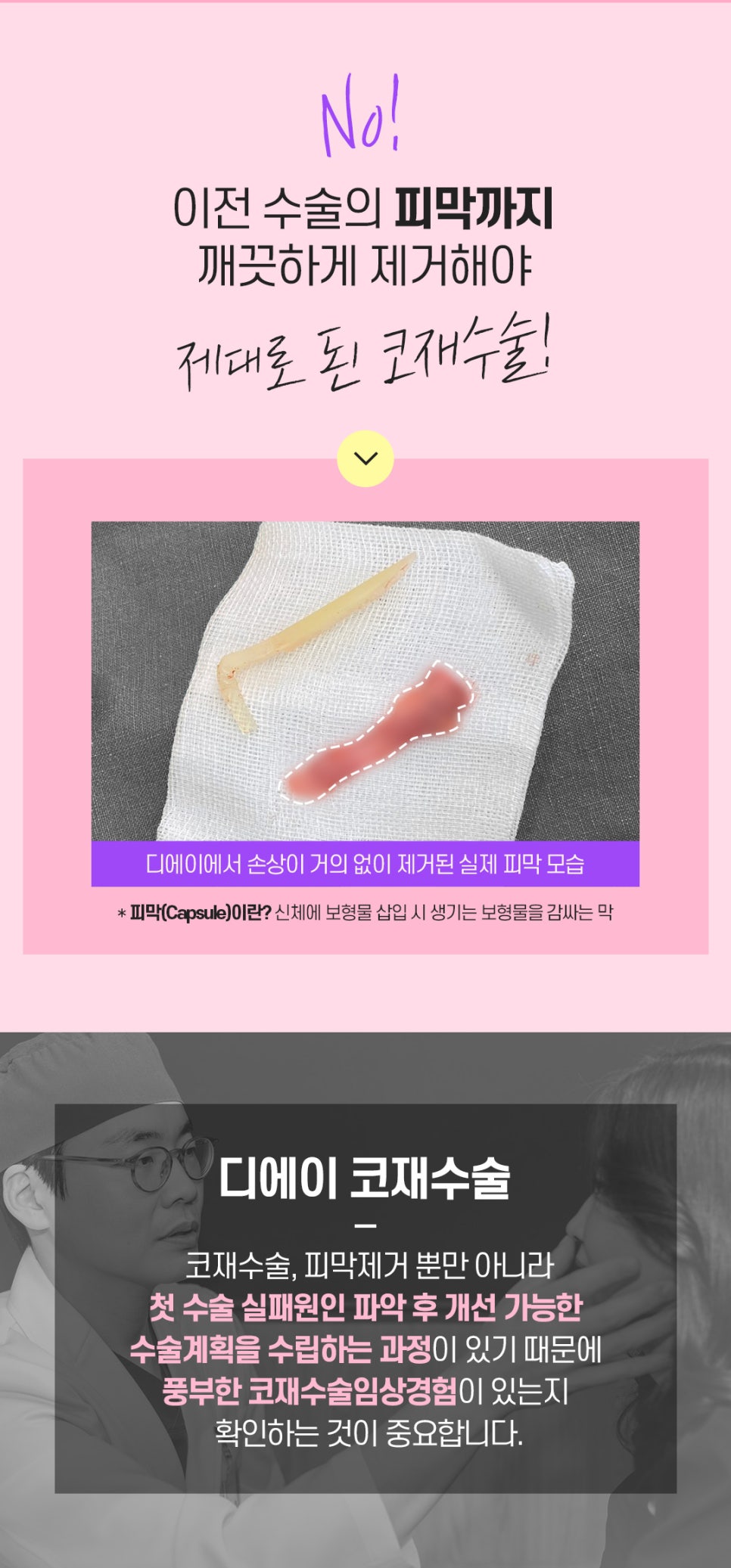 코재수술 후기 비용 신중하게 따져봐야 관련 이미지 3