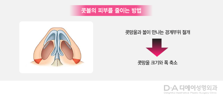 유형별 코성형의 특징과 방법 관련 이미지 15