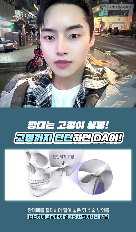 남자광대축소, 얼굴형과 옆광대 돌출을 함께 고려해야 하는 이유 관련 이미지 7