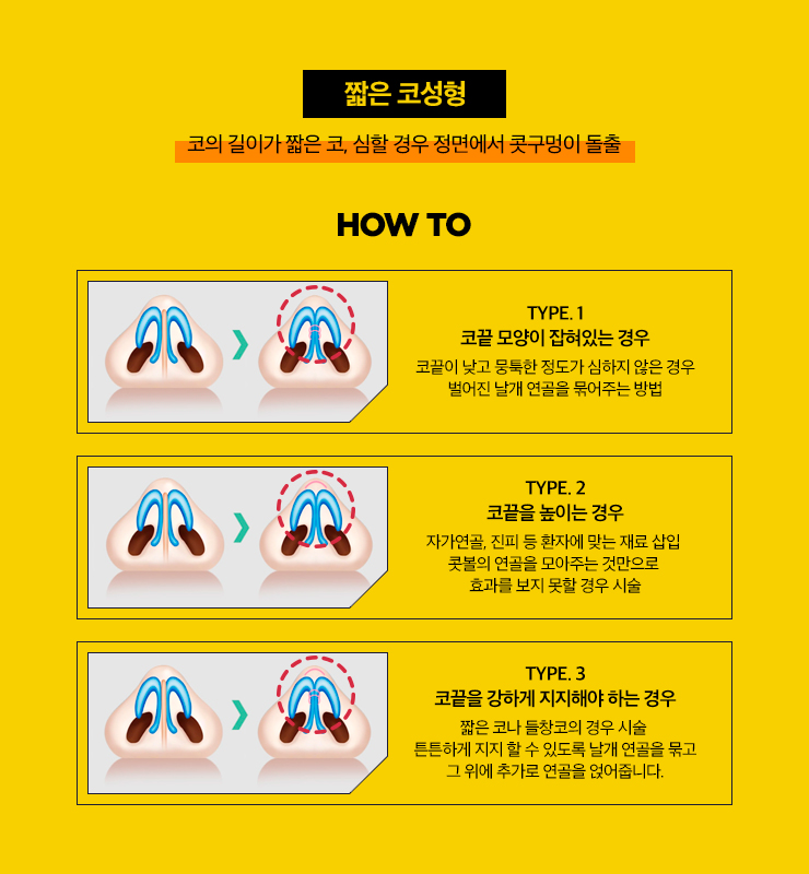 코 성형의 완성! 코끝 성형 관련 이미지 4