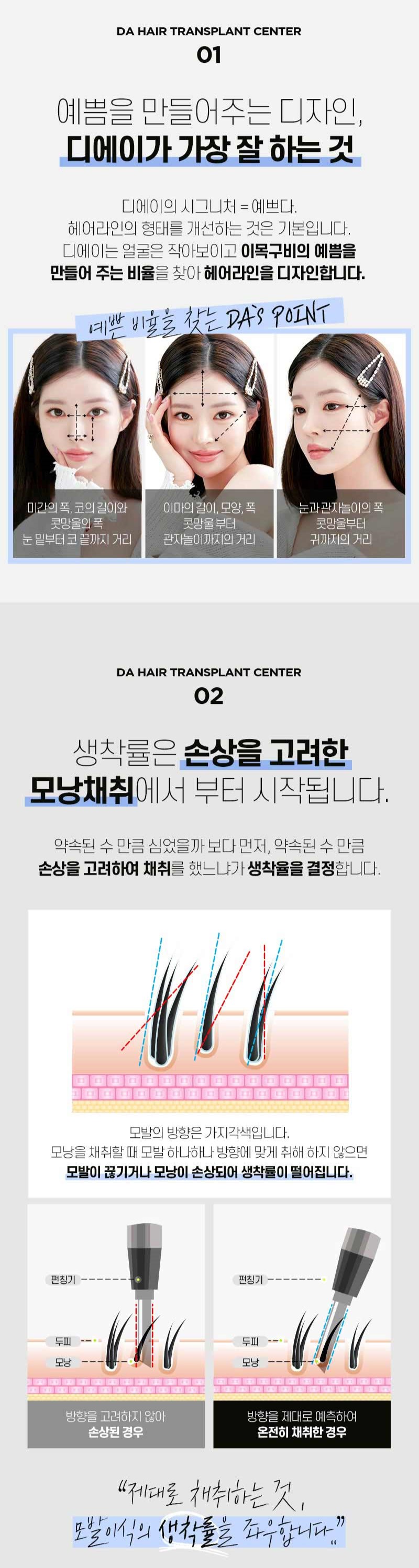 헤어라인 모발이식으로 인형외모갖기 관련 이미지 4