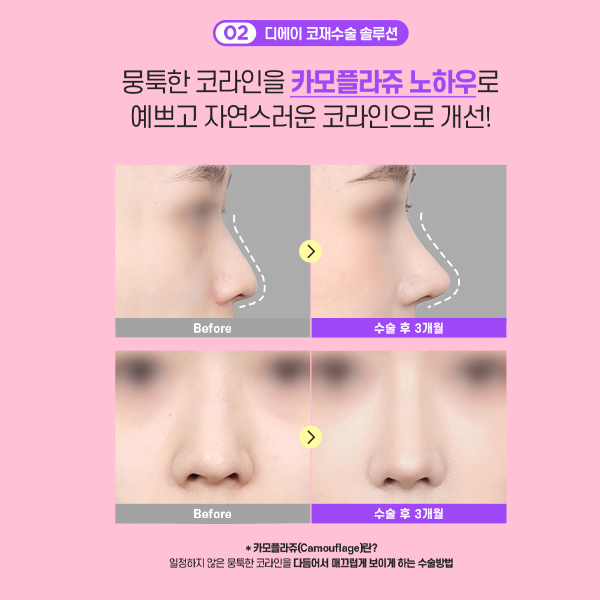 코재수술의 종착점, 더 이상 실패하지 않는 방법 관련 이미지 4