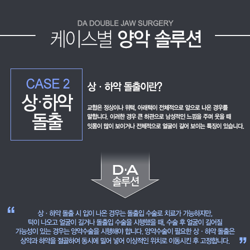 [DA성형외과 스마일양악수술]케이스별 양악솔루션을 소개합니다. 관련 이미지 2