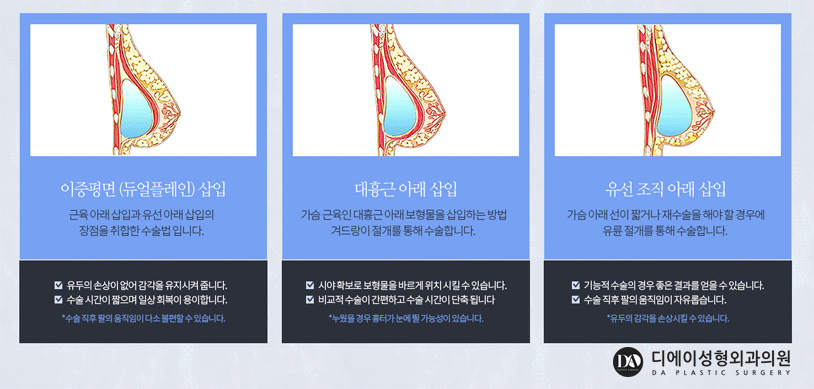 가슴성형 보형물 선택 방법 관련 이미지 4