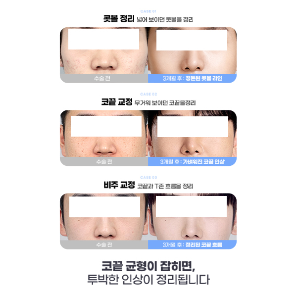 Type-Specific Male Rhinoplasty: A Natural, Refined Impression That Feels Like Your Own Nose image 7