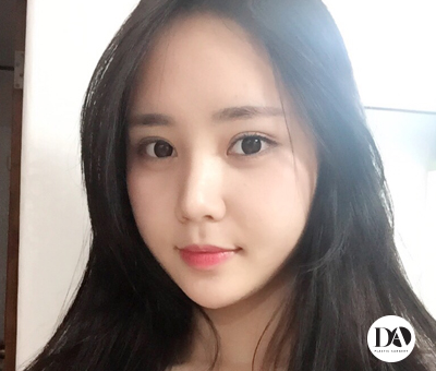 디에이성형외과 눈성형, 예쁘면DA야 관련 이미지 3