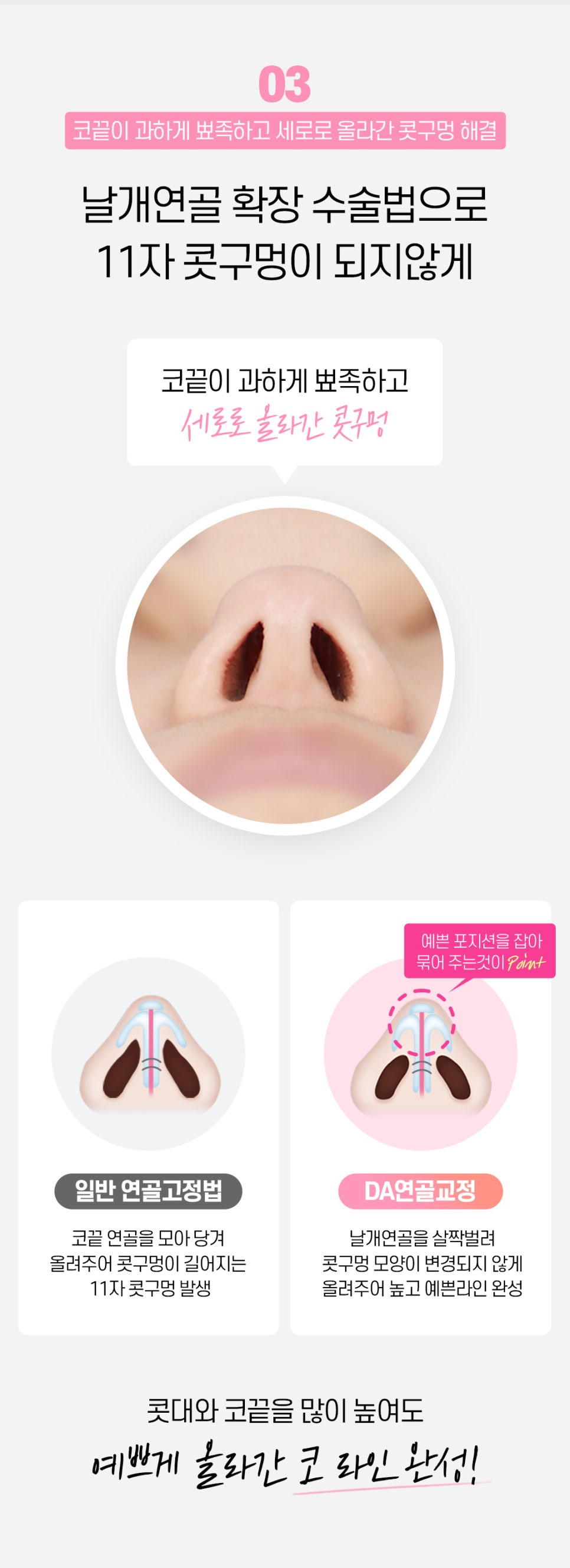 마지막 코재수술 원한다면♡ [DA성형외과] 관련 이미지 8
