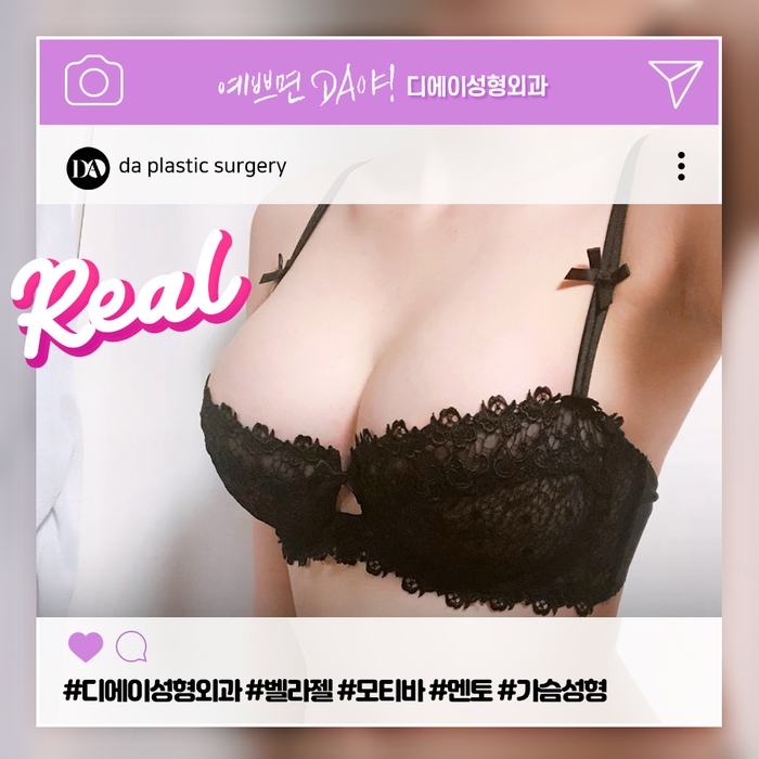 가슴성형 시작은 보형물 선택에서부터! 보형물 종류와 주의사항 관련 이미지 4