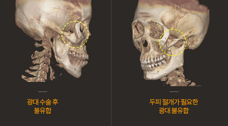 안면윤곽 재수술 체크리스트 관련 이미지 14